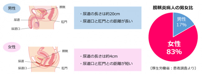 尿路結石