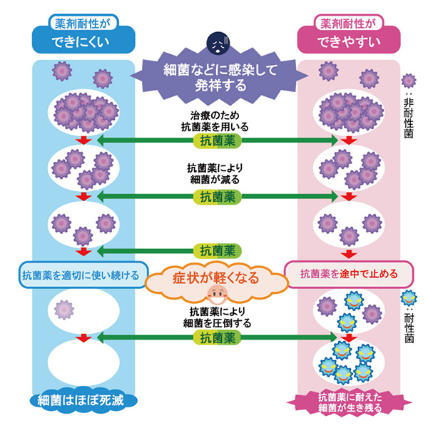 尿路結石