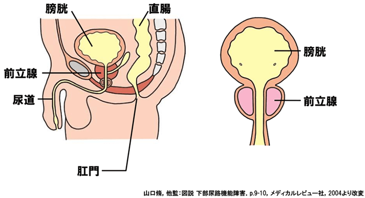 前立腺肥大症のイメージ