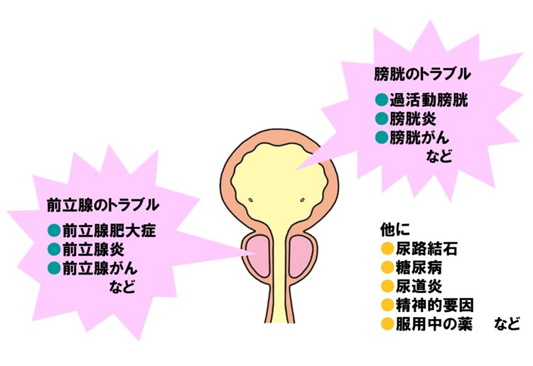 排尿障害の原因などのイメージ
