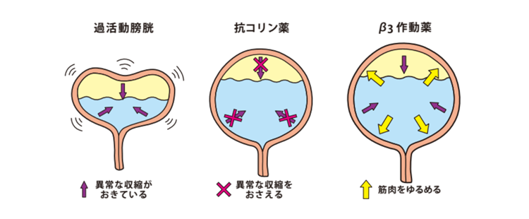 過活動膀胱のイメージ