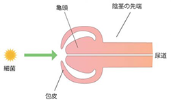 亀頭包皮炎