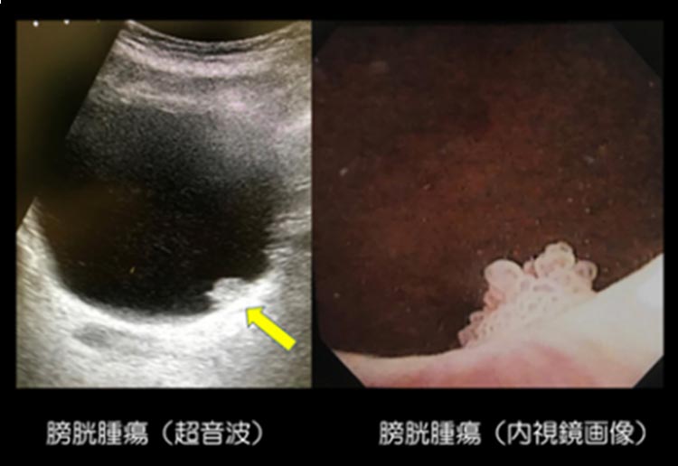 肉眼的血尿イメージ