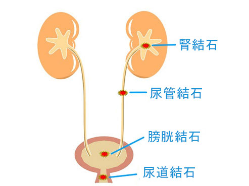 尿路結石
